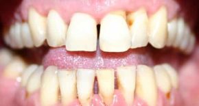 Пародонтит - болезнь зубов и десен у человека